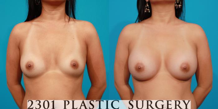 Before & After Saline Implants Case 89 View #1 View in Fort Worth, Plano, & Frisco, Texas