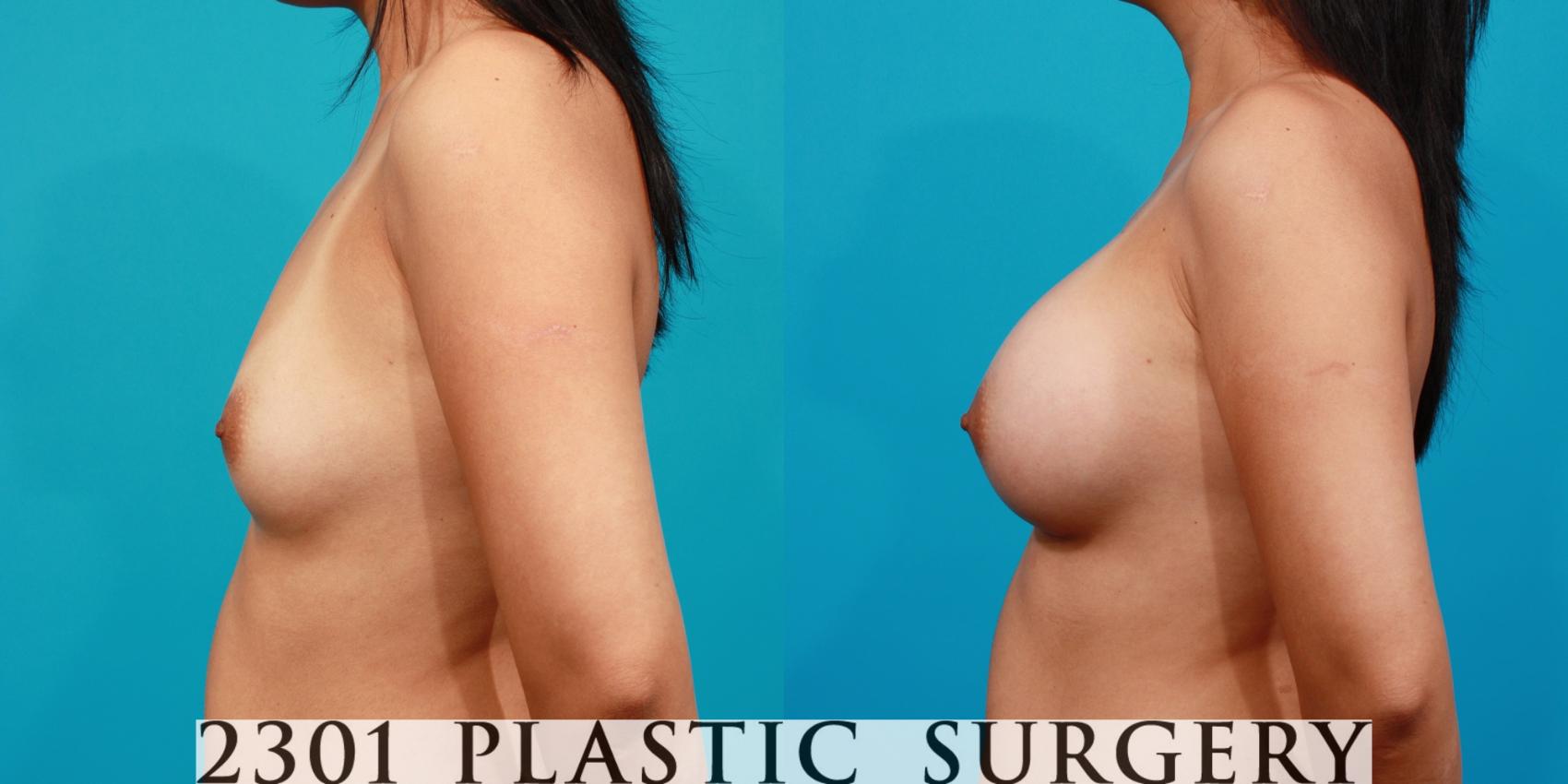 Before & After Saline Implants Case 89 View #2 View in Fort Worth & Frisco, Texas