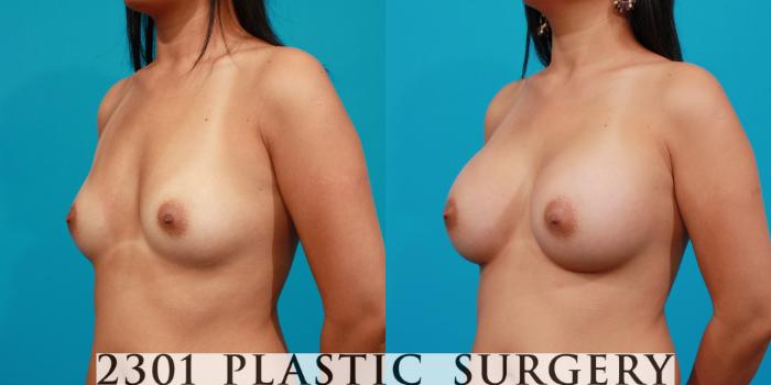 Before & After Saline Implants Case 89 View #3 View in Fort Worth, Plano, & Frisco, Texas