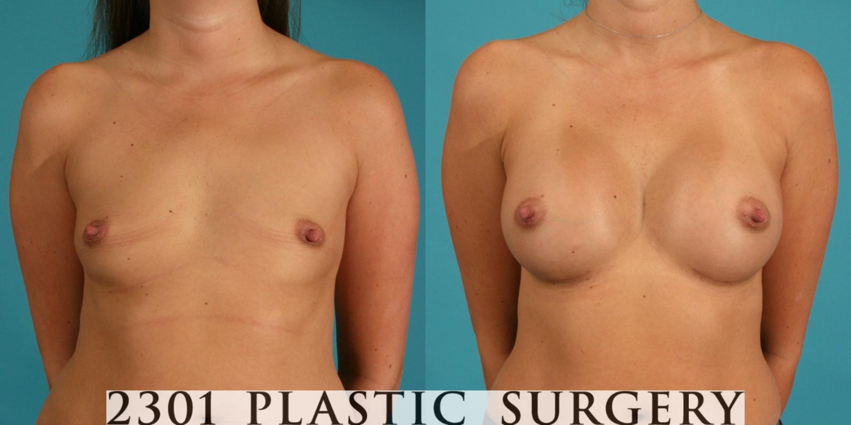 Before & After Silicone Implants Case 10 View #1 View in Fort Worth, Plano, & Frisco, Texas
