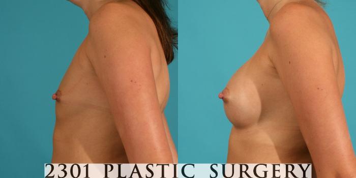 Before & After Silicone Implants Case 10 View #2 View in Fort Worth, Plano, & Frisco, Texas