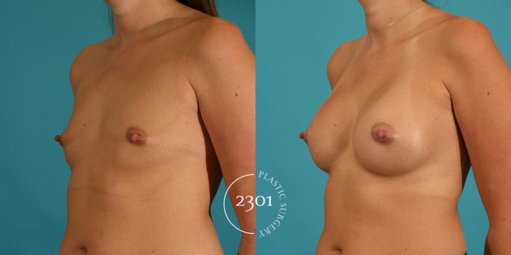 Before & After Silicone Implants Case 10 View #3 View in Fort Worth, Plano, & Frisco, Texas