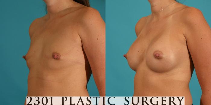 Before & After Silicone Implants Case 10 View #3 View in Fort Worth, Plano, & Frisco, Texas