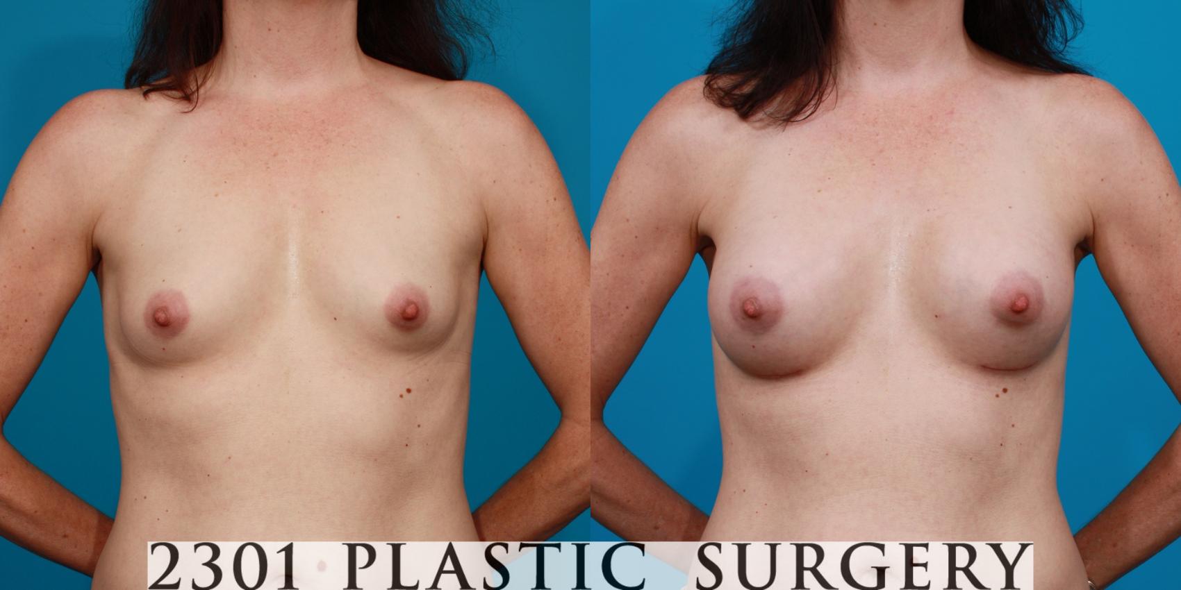 Before & After Silicone Implants Case 100 View #1 View in Fort Worth, Plano, & Frisco, Texas