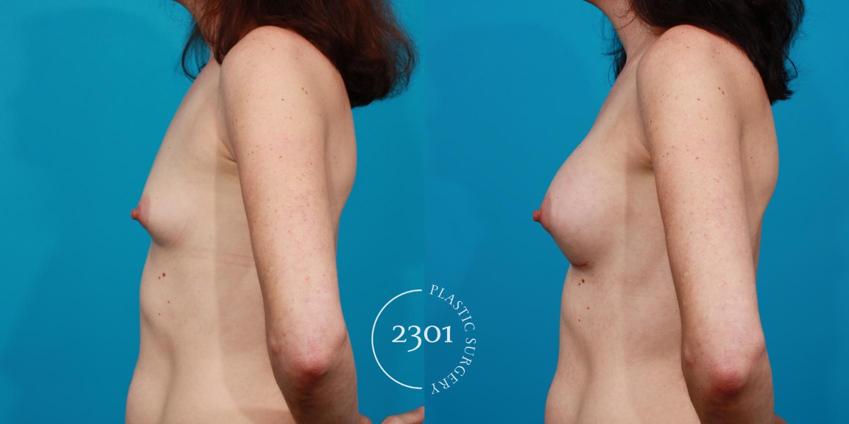 Before & After Silicone Implants Case 100 View #2 View in Fort Worth, Plano, & Frisco, Texas