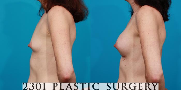 Before & After Silicone Implants Case 100 View #2 View in Fort Worth, Plano, & Frisco, Texas