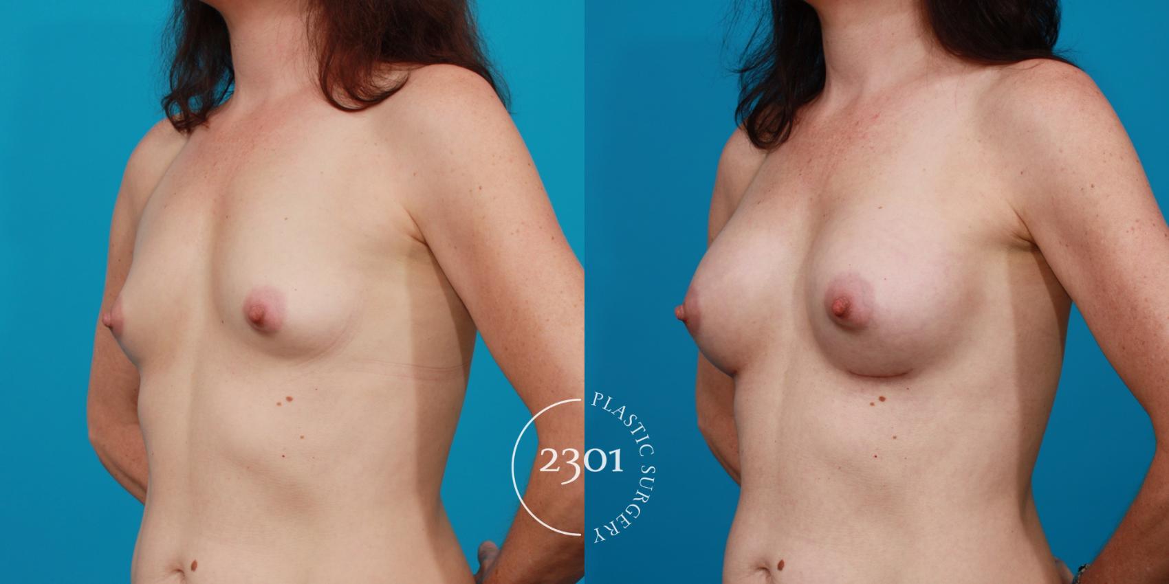 Before & After Silicone Implants Case 100 View #3 View in Fort Worth, Plano, & Frisco, Texas