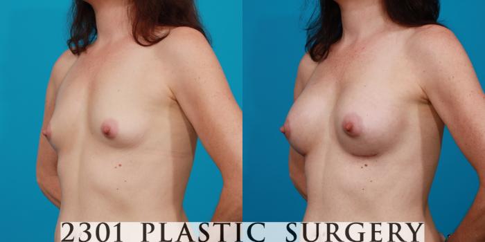 Before & After Silicone Implants Case 100 View #3 View in Fort Worth, Plano, & Frisco, Texas