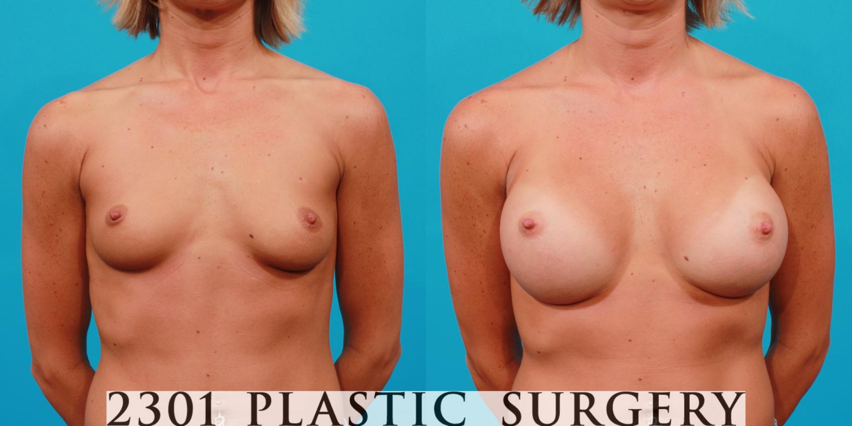 Before & After Silicone Implants Case 101 View #1 View in Fort Worth & Frisco, Texas