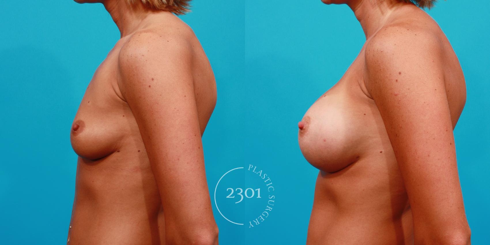 Before & After Breast Augmentation Case 101 View #2 View in Fort Worth, Plano, & Frisco, Texas