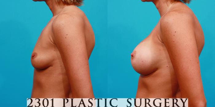 Before & After Breast Augmentation Case 101 View #2 View in Fort Worth, Plano, & Frisco, Texas