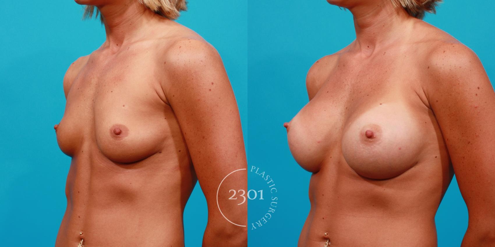 Before & After Breast Augmentation Case 101 View #3 View in Fort Worth, Plano, & Frisco, Texas