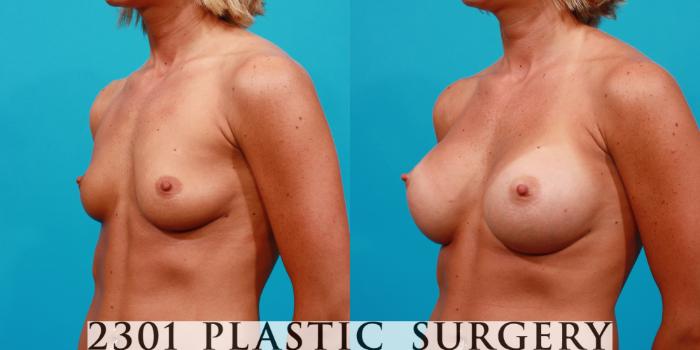 Before & After Breast Augmentation Case 101 View #3 View in Fort Worth, Plano, & Frisco, Texas
