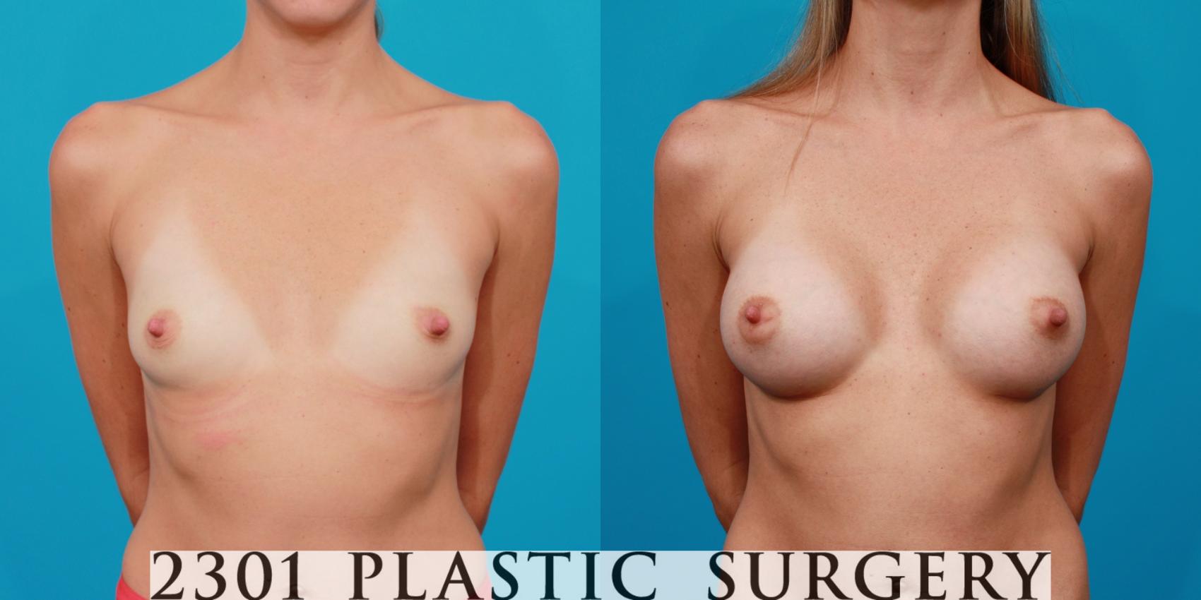 Before & After Silicone Implants Case 105 View #1 View in Fort Worth, Plano, & Frisco, Texas