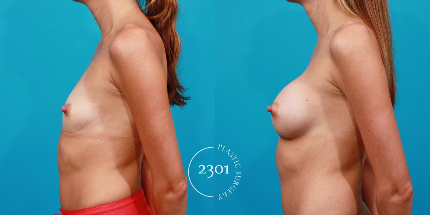 Before & After Silicone Implants Case 105 View #2 View in Fort Worth, Plano, & Frisco, Texas