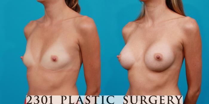 Before & After Silicone Implants Case 105 View #3 View in Fort Worth, Plano, & Frisco, Texas