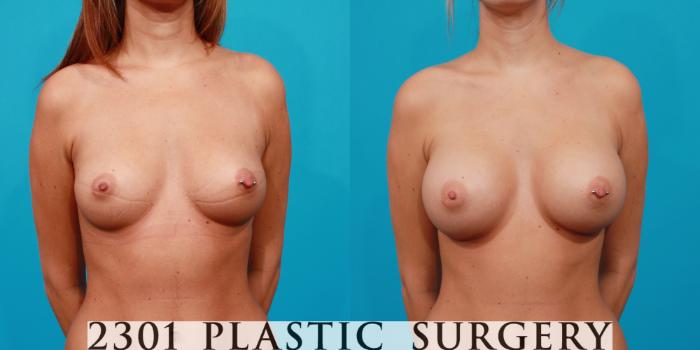 Before & After Breast Augmentation Case 109 View #1 View in Fort Worth, Plano, & Frisco, Texas
