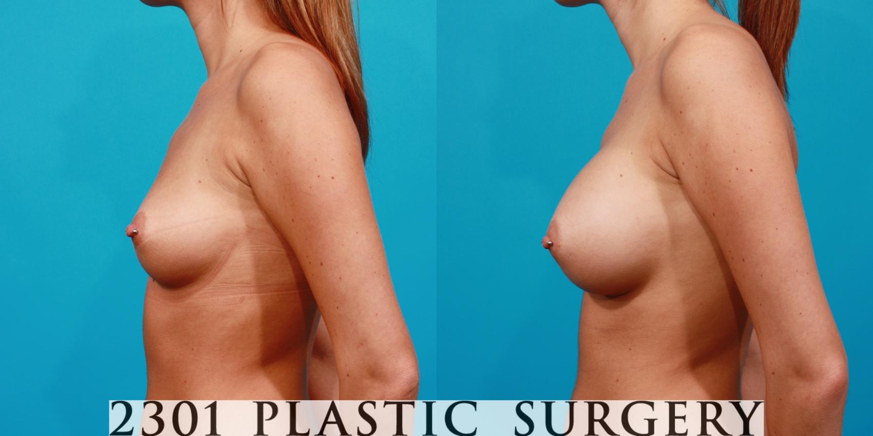 Before & After Silicone Implants Case 109 View #2 View in Fort Worth & Frisco, Texas