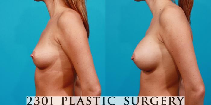 Before & After Silicone Implants Case 109 View #2 View in Fort Worth, Plano, & Frisco, Texas