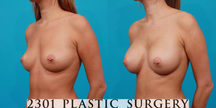 Before & After Silicone Implants Case 109 View #3 View in Fort Worth, Plano, & Frisco, Texas