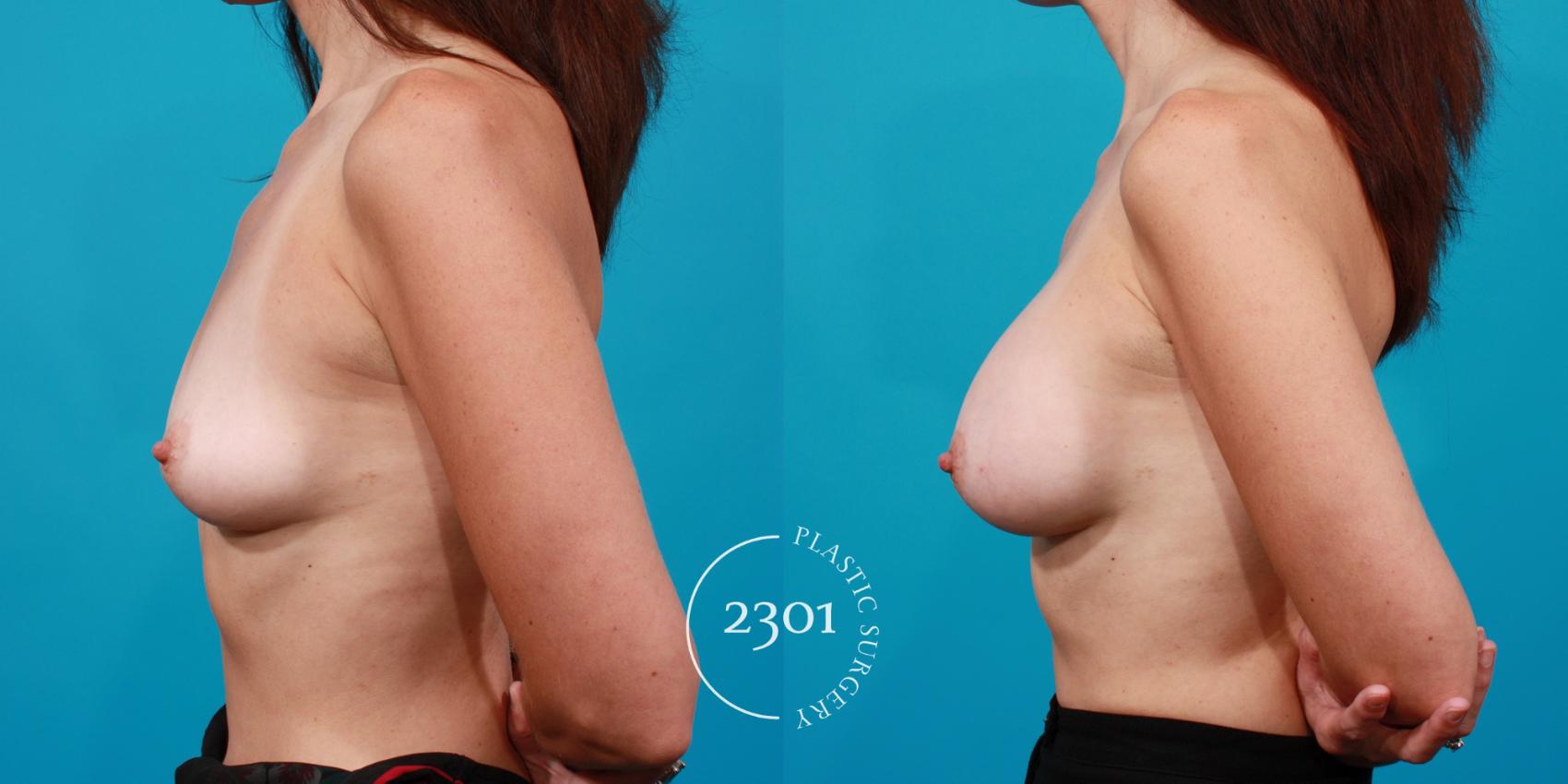 Before & After Silicone Implants Case 111 View #2 View in Fort Worth, Plano, & Frisco, Texas
