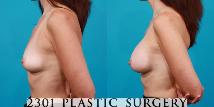 Before & After Silicone Implants Case 111 View #2 View in Fort Worth, Plano, & Frisco, Texas