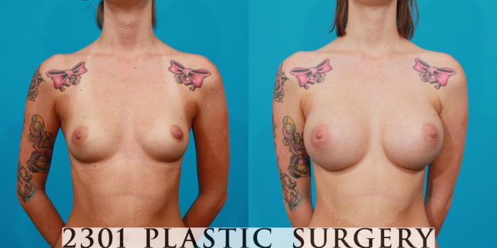 Before & After Silicone Implants Case 112 View #1 View in Fort Worth, Plano, & Frisco, Texas
