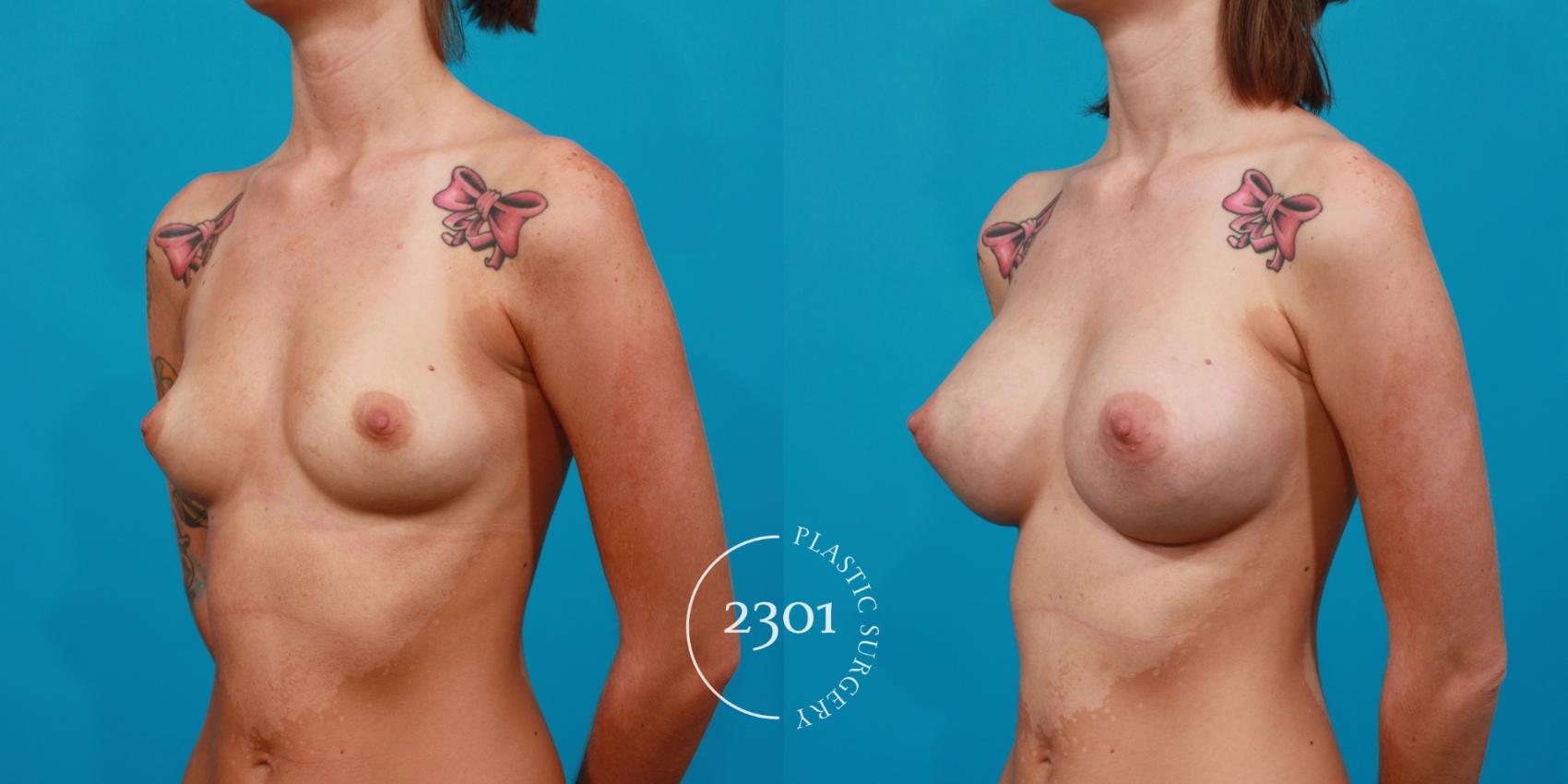 Before & After Silicone Implants Case 112 View #3 View in Fort Worth, Plano, & Frisco, Texas