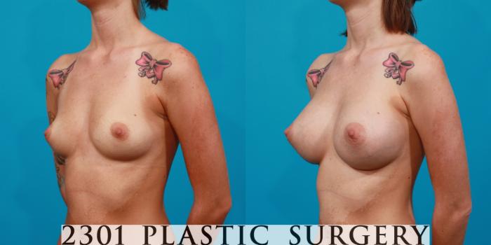 Before & After Breast Augmentation Case 112 View #3 View in Fort Worth, Plano, & Frisco, Texas