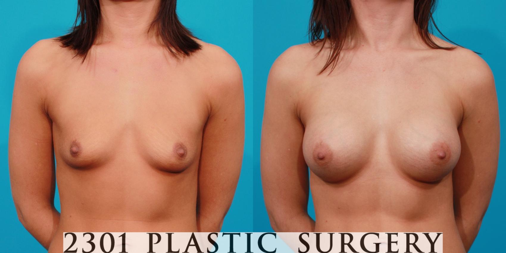 Before & After Breast Augmentation Case 116 View #1 View in Fort Worth & Frisco, Texas