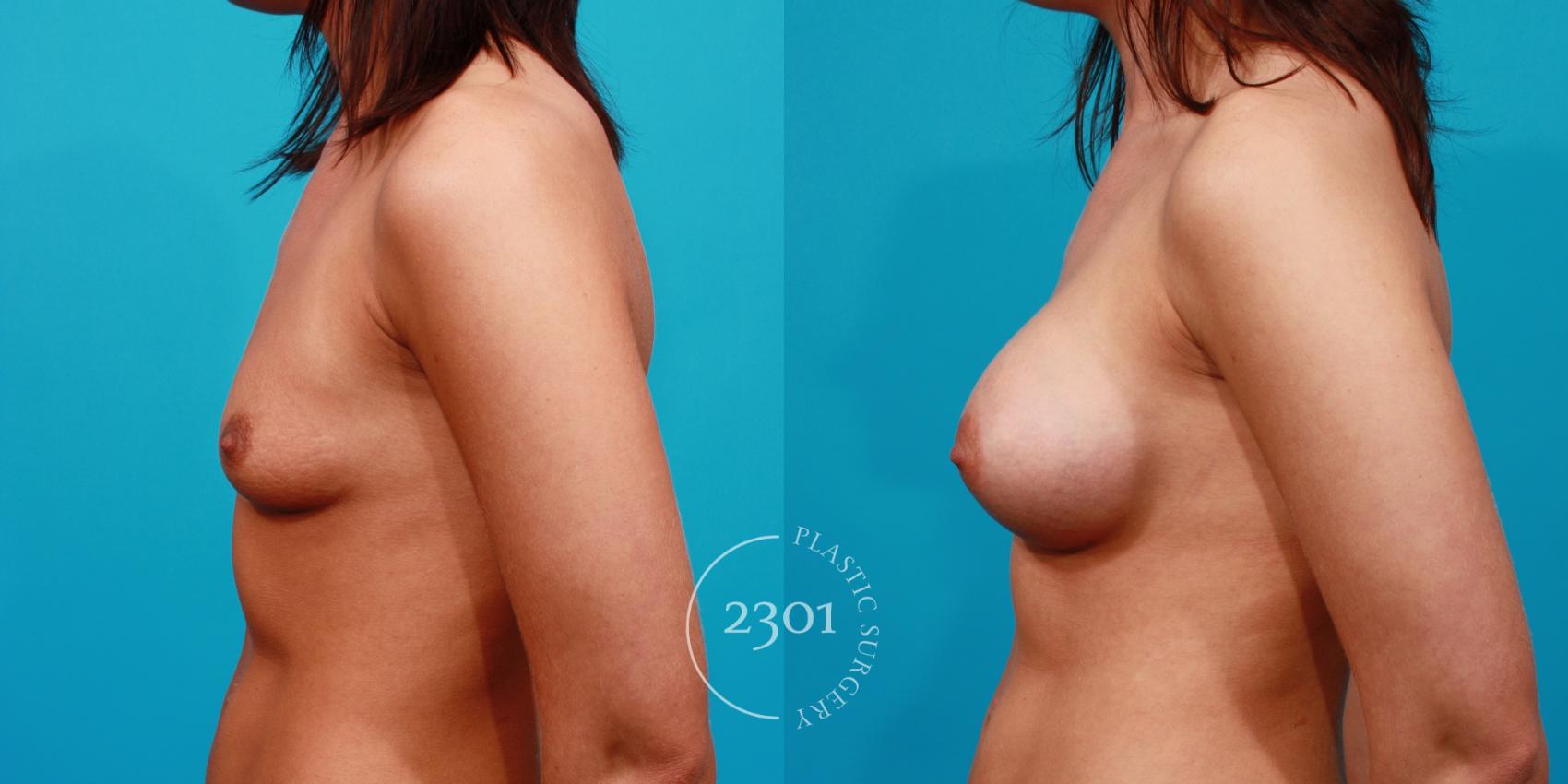 Before & After Breast Augmentation Case 116 View #2 View in Fort Worth, Plano, & Frisco, Texas