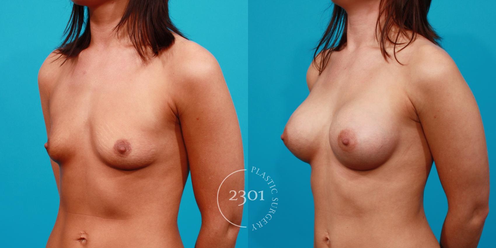 Before & After Breast Augmentation Case 116 View #3 View in Fort Worth, Plano, & Frisco, Texas