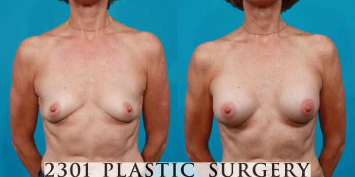 Before & After Silicone Implants Case 124 View #1 View in Fort Worth, Plano, & Frisco, Texas