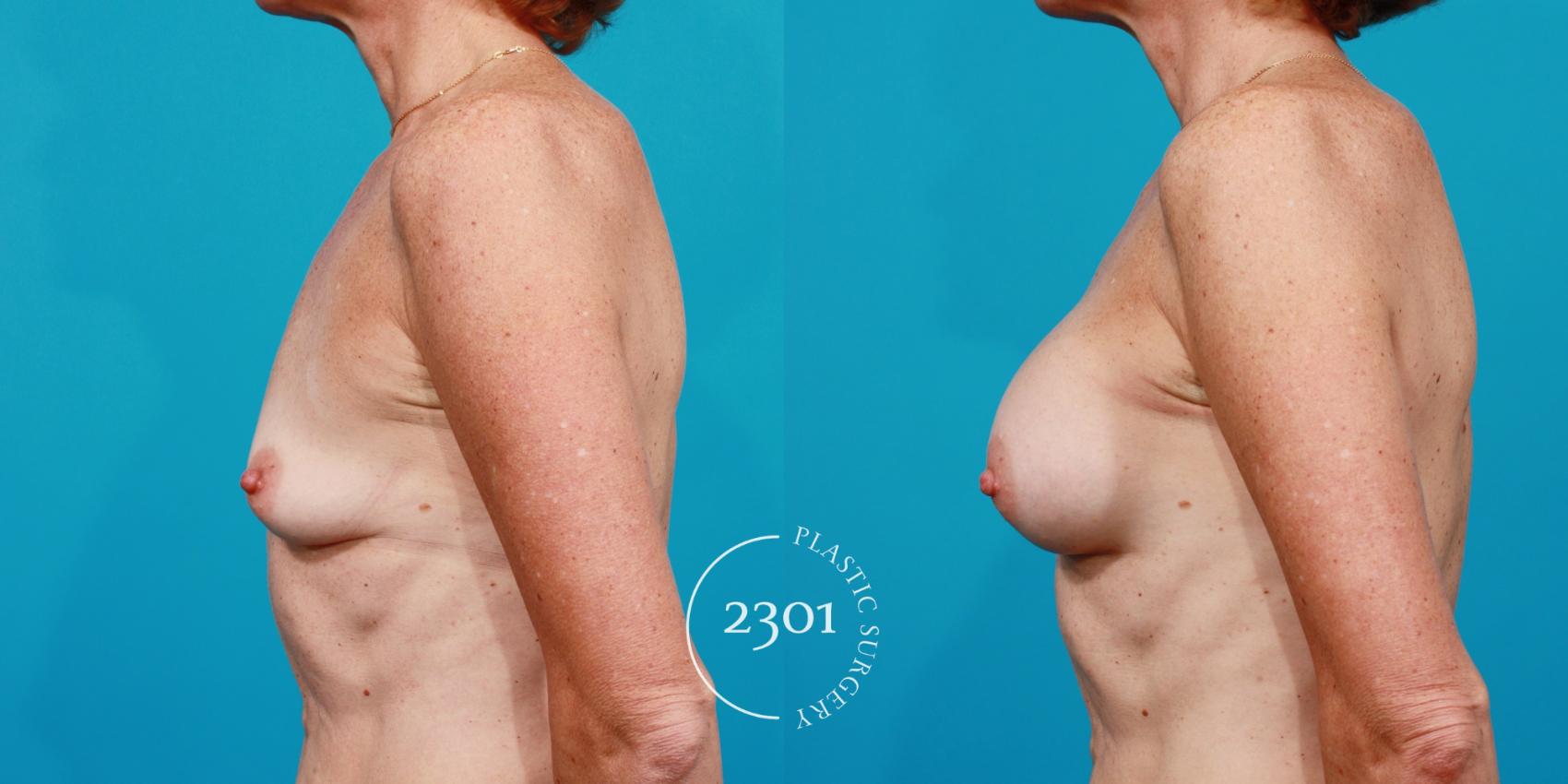 Before & After Silicone Implants Case 124 View #2 View in Fort Worth, Plano, & Frisco, Texas