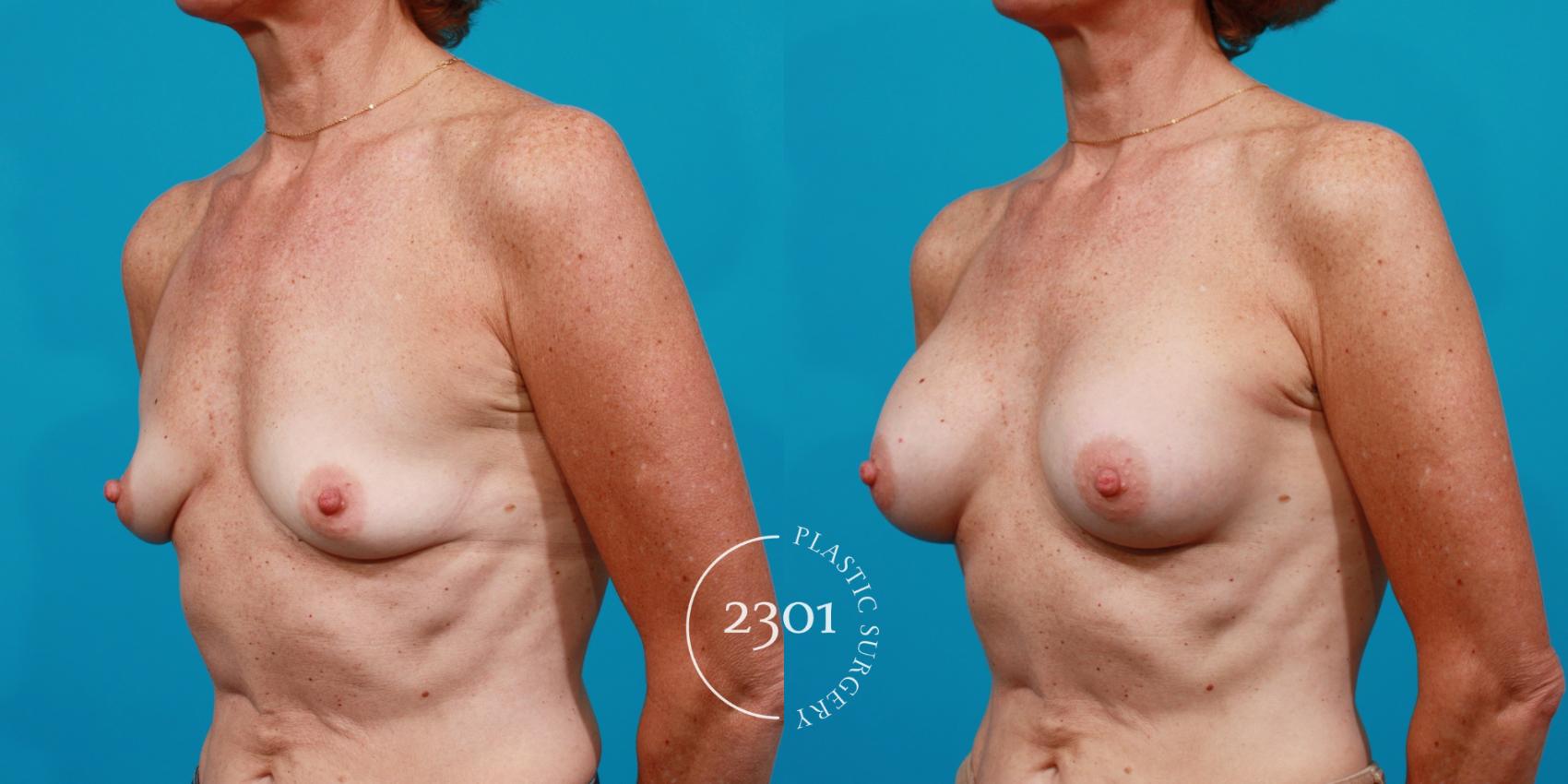 Before & After Silicone Implants Case 124 View #3 View in Fort Worth, Plano, & Frisco, Texas