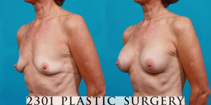 Before & After Silicone Implants Case 124 View #3 View in Fort Worth, Plano, & Frisco, Texas