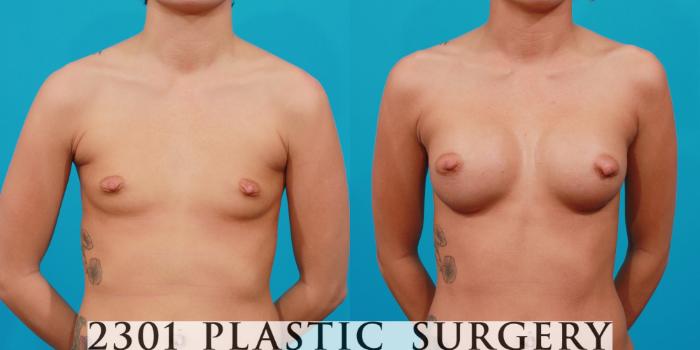 Before & After Silicone Implants Case 128 View #1 View in Fort Worth, Plano, & Frisco, Texas