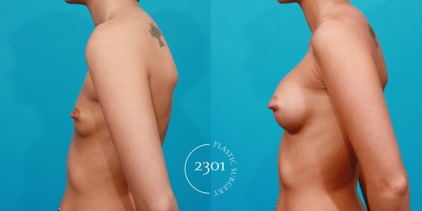 Before & After Silicone Implants Case 128 View #2 View in Fort Worth, Plano, & Frisco, Texas