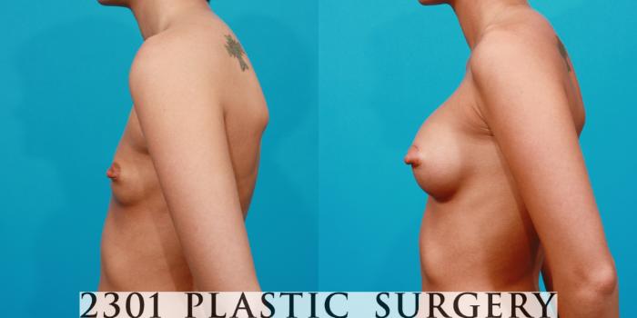 Before & After Breast Augmentation Case 128 View #2 View in Fort Worth, Plano, & Frisco, Texas