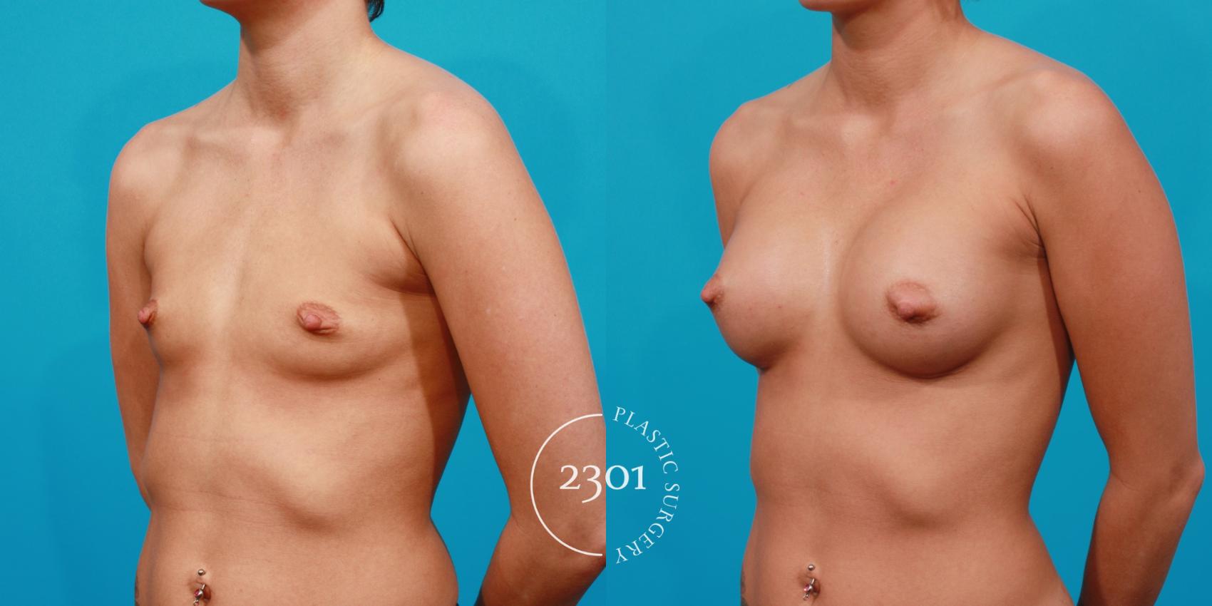 Before & After Silicone Implants Case 128 View #3 View in Fort Worth, Plano, & Frisco, Texas