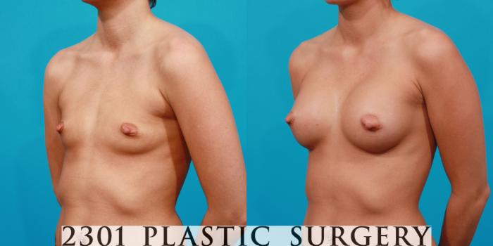 Before & After Breast Augmentation Case 128 View #3 View in Fort Worth, Plano, & Frisco, Texas