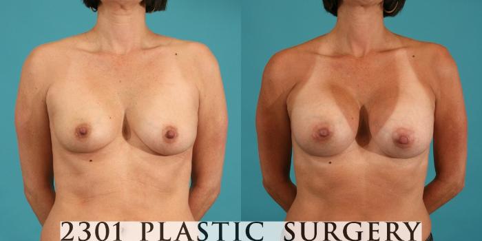 Before & After Silicone Implants Case 13 View #1 View in Fort Worth, Plano, & Frisco, Texas