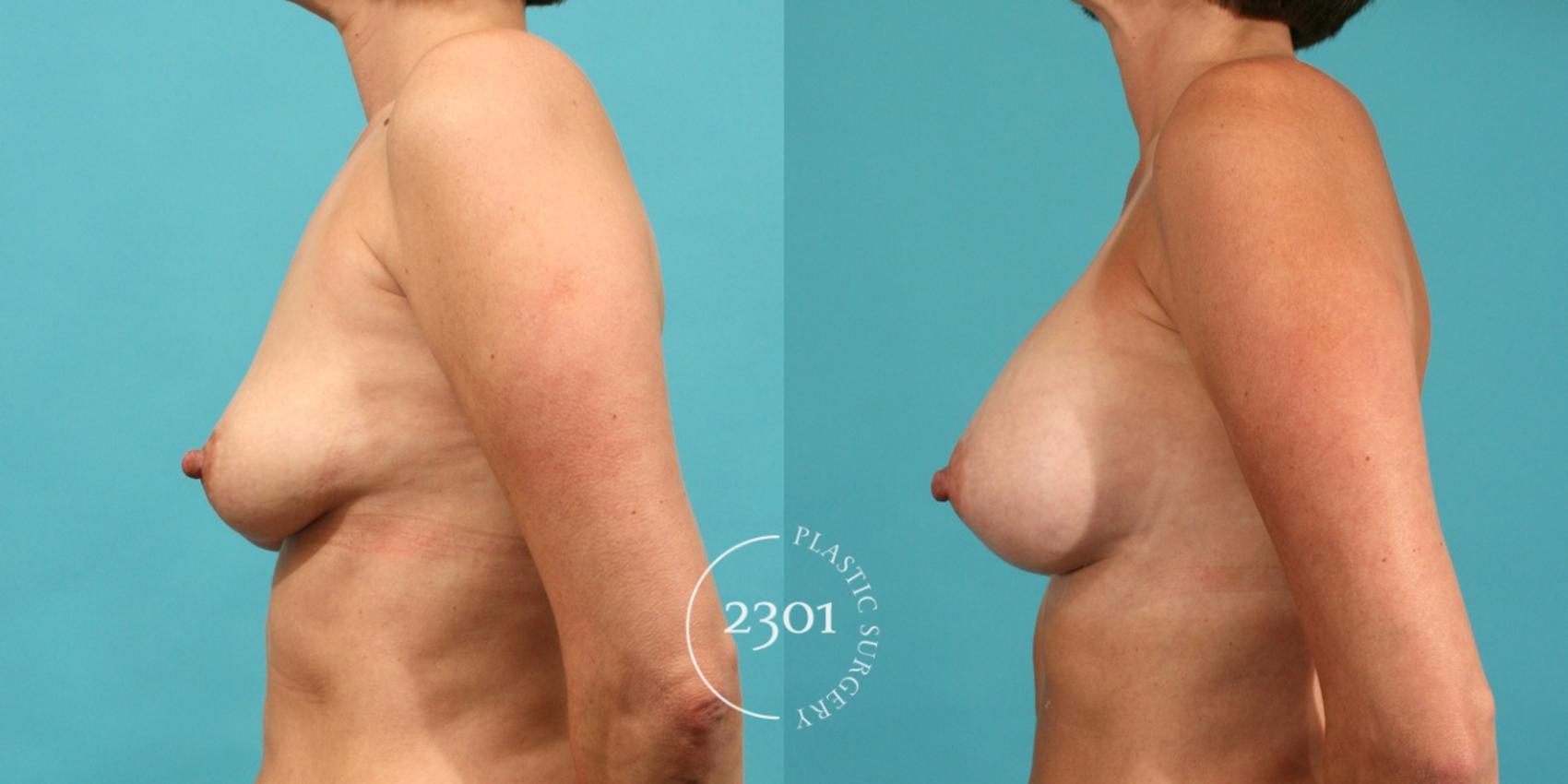 Before & After Silicone Implants Case 13 View #2 View in Fort Worth, Plano, & Frisco, Texas