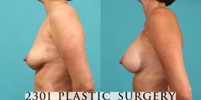 Before & After Breast Augmentation Case 13 View #2 View in Fort Worth, Plano, & Frisco, Texas