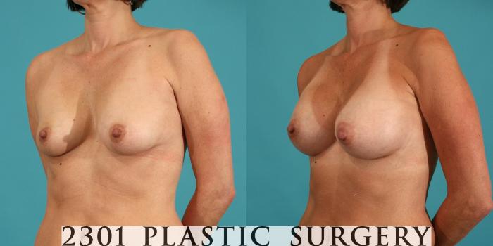 Before & After Silicone Implants Case 13 View #3 View in Fort Worth, Plano, & Frisco, Texas