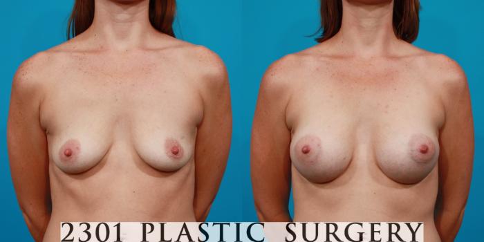 Before & After Silicone Implants Case 130 View #1 View in Fort Worth, Plano, & Frisco, Texas