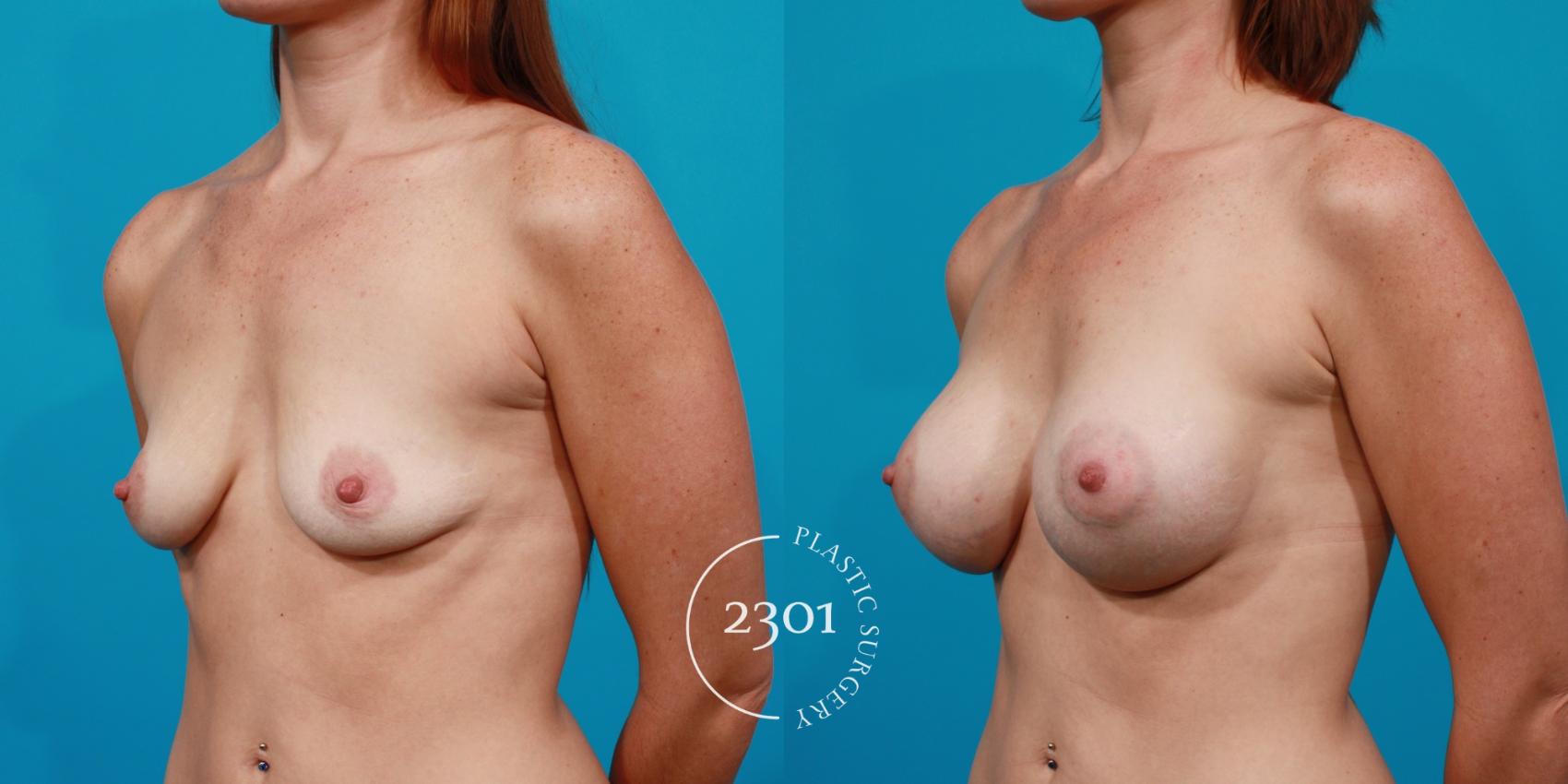 Before & After Silicone Implants Case 130 View #3 View in Fort Worth, Plano, & Frisco, Texas