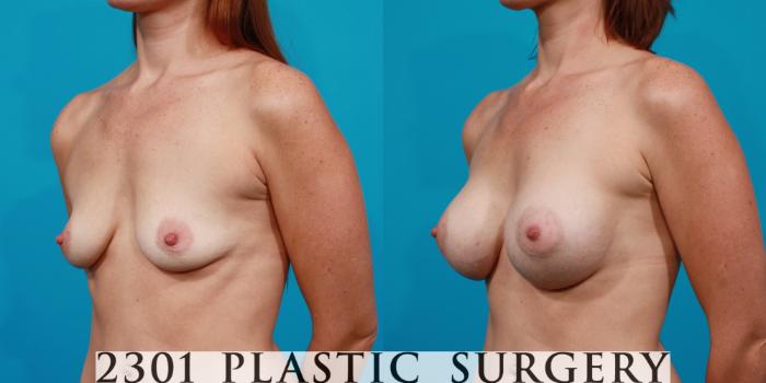 Before & After Silicone Implants Case 130 View #3 View in Fort Worth, Plano, & Frisco, Texas