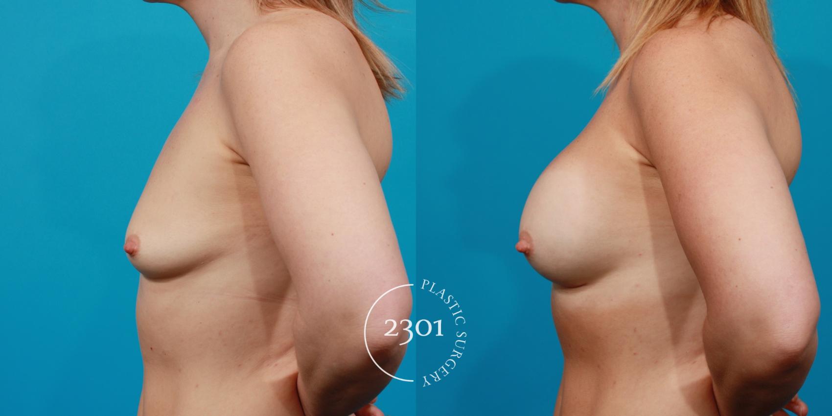 Before & After Silicone Implants Case 132 View #2 View in Fort Worth, Plano, & Frisco, Texas