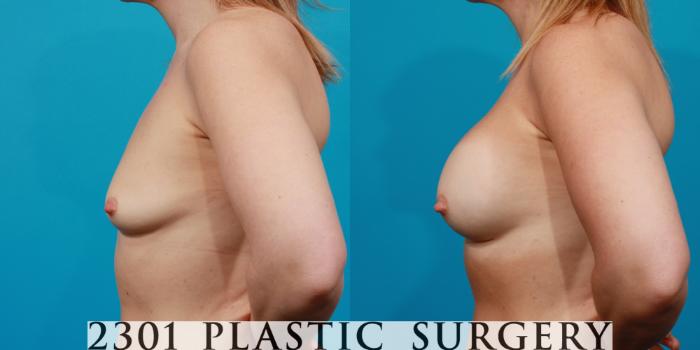 Before & After Breast Augmentation Case 132 View #2 View in Fort Worth, Plano, & Frisco, Texas